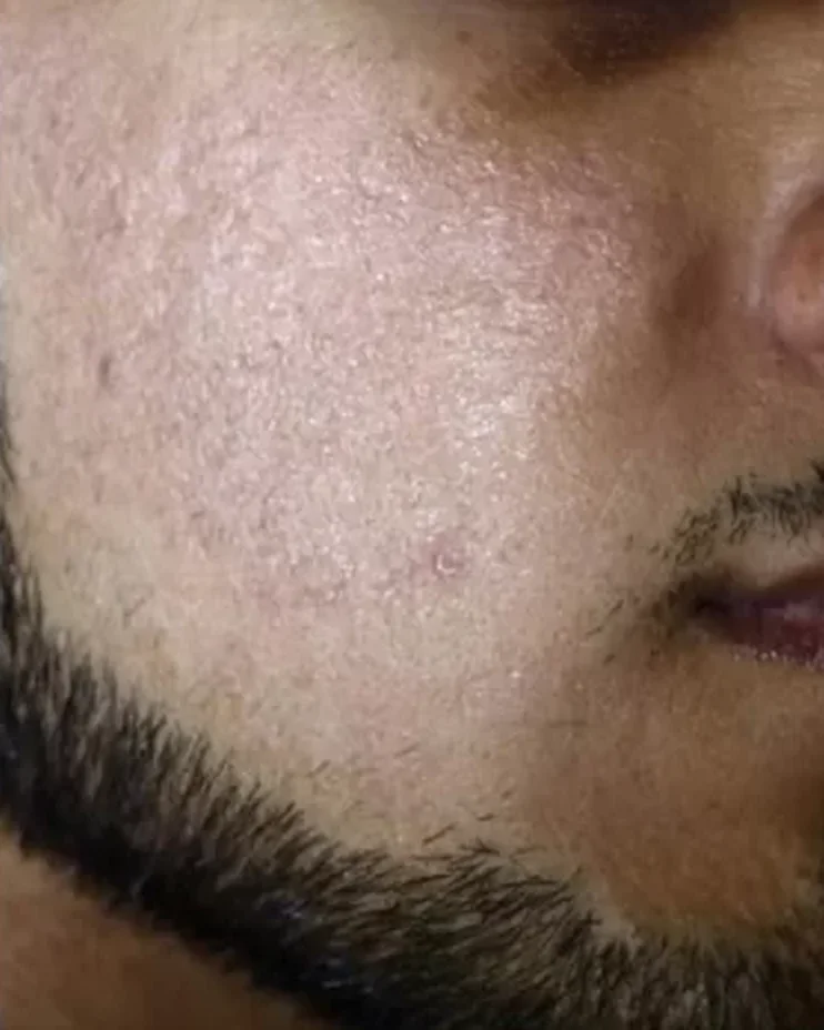 After treatment