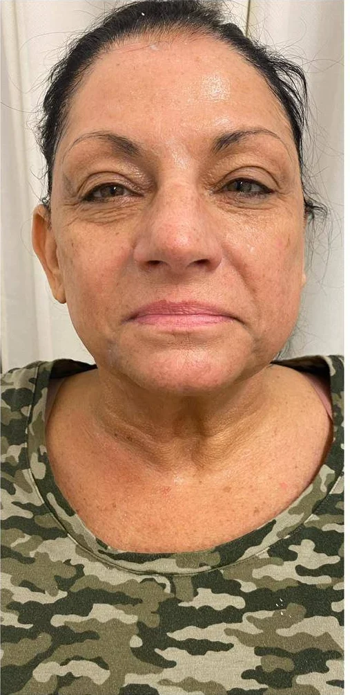 After — Jawline & neck
