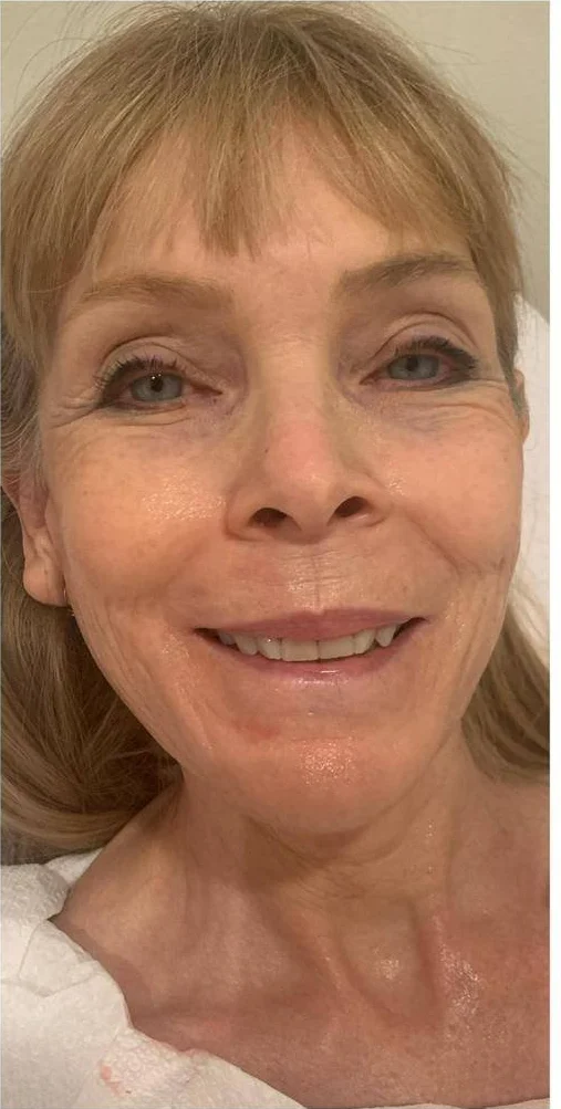 After — Crow's feet & glow