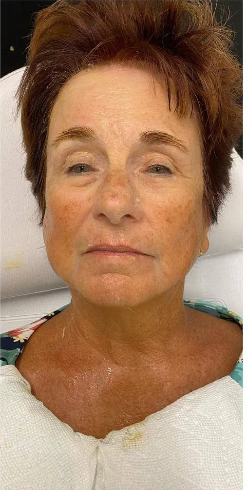 After — Overall rejuvenation